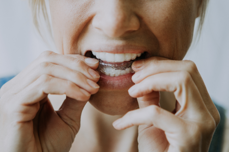 Girl putting on clear aligners