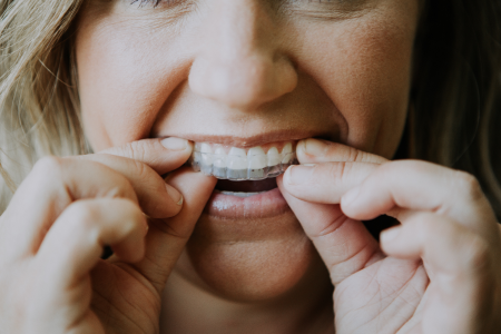 Girl putting on clear aligners