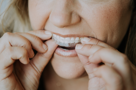 Girl putting on clear aligners from the side angle